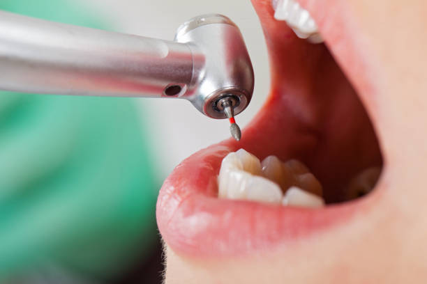 Best Emergency Broken Tooth Repair in Milford, NJ